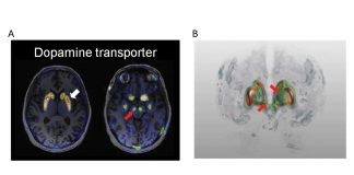 A new method to map the dopamine system in Parkinson’s patients
