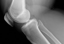 The man behind bioactive glass for wound healing Bone