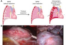 Malignant pleural mesothelioma: from bedside to bench and from bench to bedside An image to illustrate malignant pleural mesothelioma