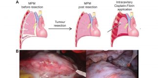 An image to illustrate malignant pleural mesothelioma