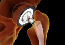 The biocompatibility of titanium nickelide for medical implants The biocompatibility of titanium nickelide for medical implants