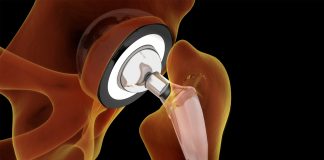 The biocompatibility of titanium nickelide for medical implants