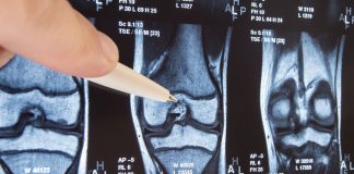 Advanced osteoarthritis: the curse and blessing of total joint arthroplasties