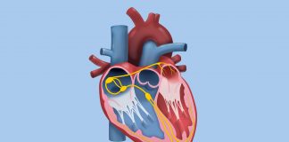 narrowed aortic valve