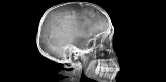 skull polymer implants