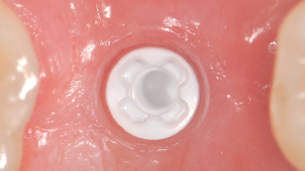 Ceramic dental implants innovation in dentistry Innovation News Network