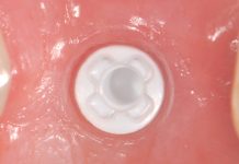 Ceramic dental implants: innovation in dentistry Ceramic dental implants