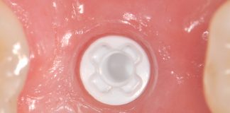 Ceramic dental implants