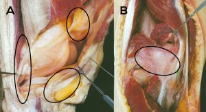 Arthrofibrosis