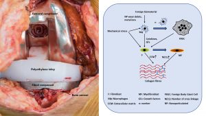 Arthrofibrosis