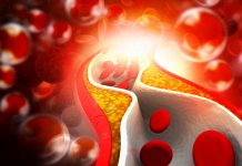 Newly discovered RNA function to improve treatment for arteriosclerosis arteriosclerosis