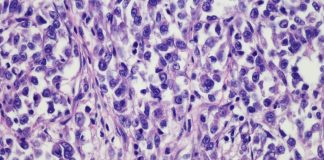 soft tissue sarcomas