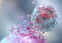 Patients with a rare bowel cancer could benefit from immunotherapy bowel cancer