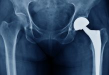 New ‘lifelike’ bone implants can react to weight in the same way as living human tissues material for bone implants