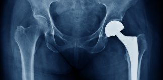 material for bone implants
