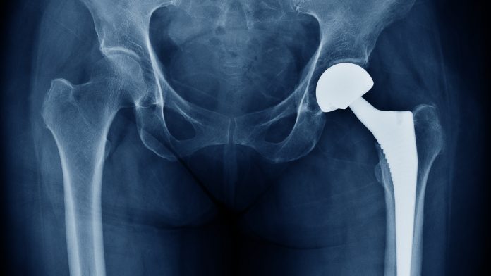 material for bone implants