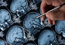 Researchers suggest an Alzheimer’s protein can help doctors stage the disease Alzheimer's protein