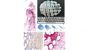 scaffold-guided breast reconstruction