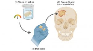 bone defect treatment