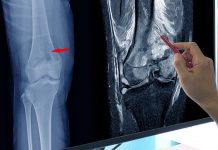 Advanced nanoplatforms for diagnosis and treatment of osteosarcoma