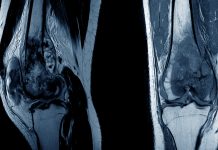 Advanced nanoplatforms for diagnosis and treatment of osteosarcoma