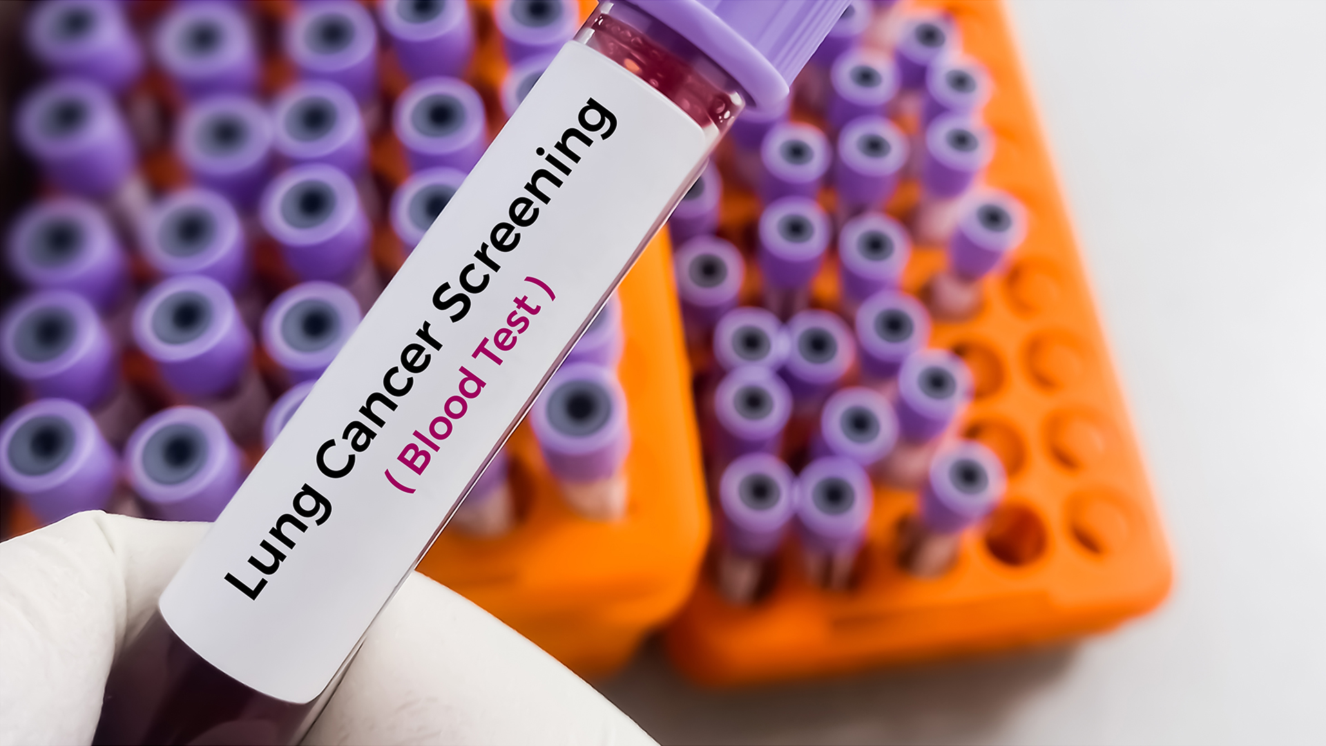 John Hopkins Medicine researchers develop AI blood test to diagnose lung cancer