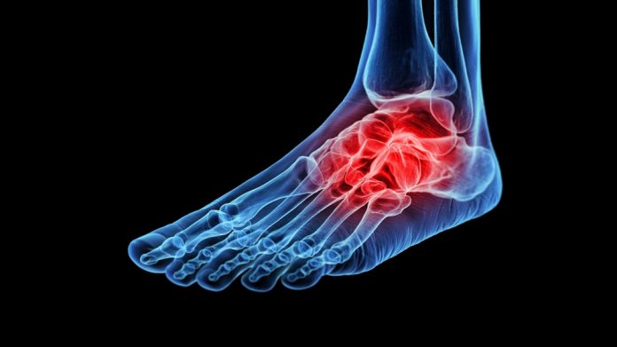 fracture-related infections