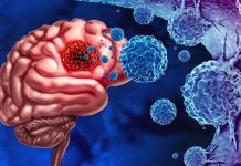 New hope for glioblastoma multiforme: NuCapCure project targets deadliest brain tumour glioblastoma multiforme