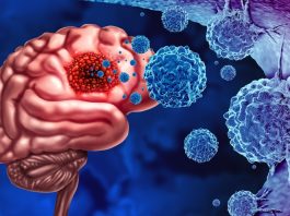 glioblastoma multiforme