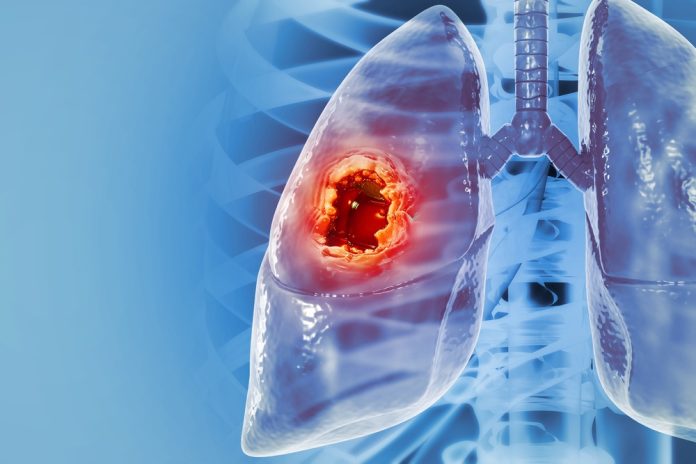 lung cancer