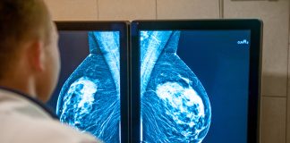 AI better at predicting breast cancer risk than density monitoring, research finds