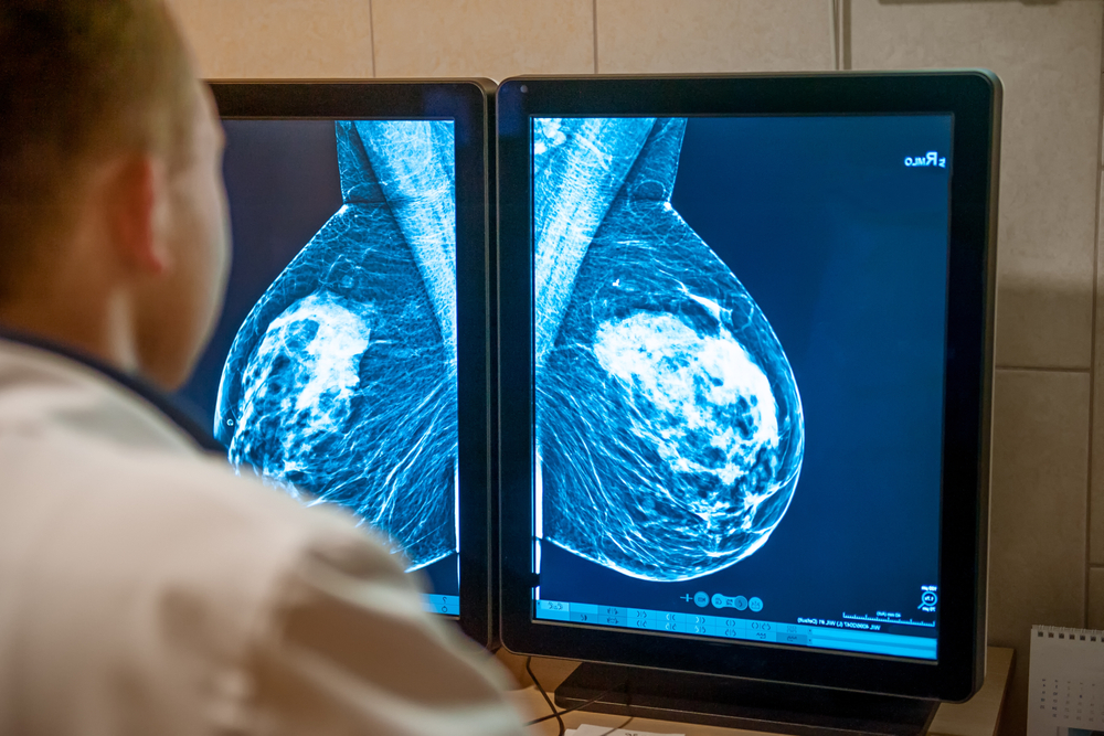 AI better at predicting breast cancer risk than density monitoring, research finds