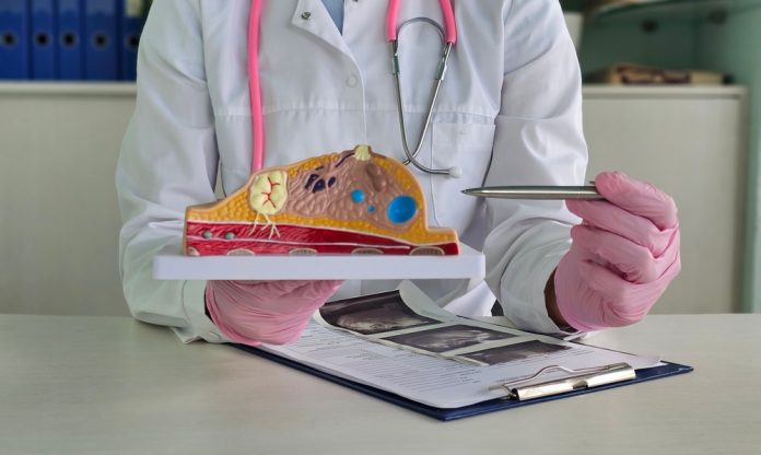 Megestrol acetate may boost breast cancer therapy